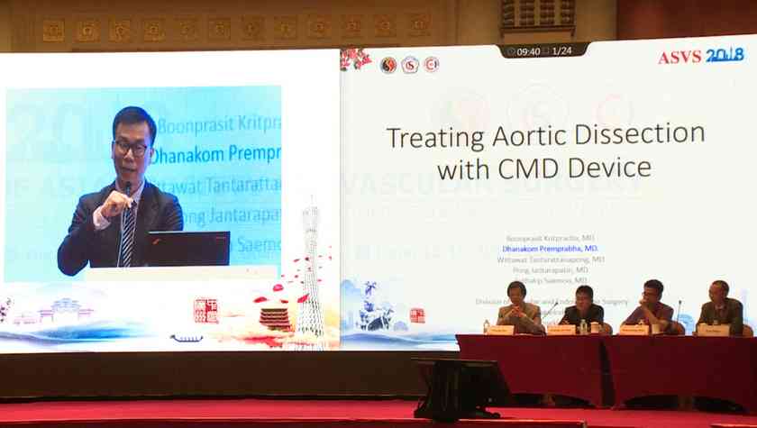 Dhanakom Premprabha：Treating Aortic Dissection with CMD Device